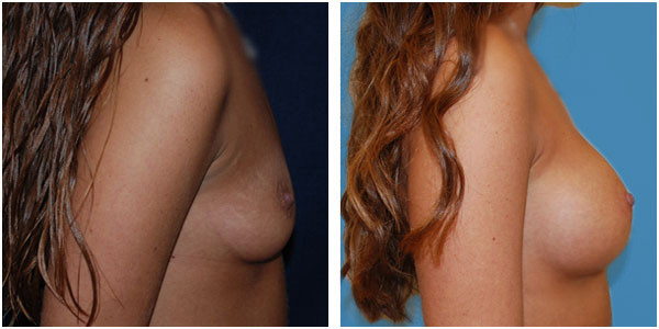A woman's breast left side view before and after surgery right side, featuring J.C