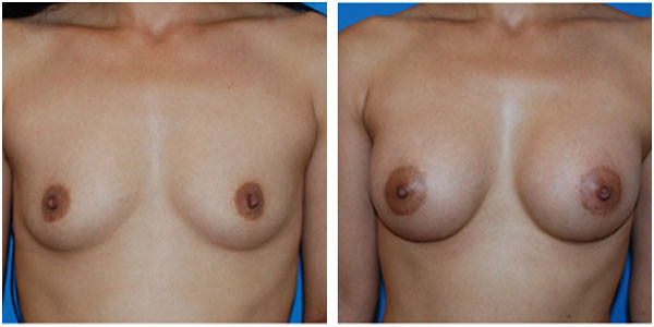 a woman breast front side view showcasing breast augmentation surgery results before and after C9