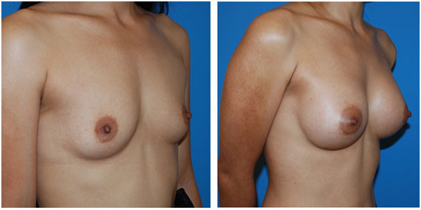 a woman breast front side view showcasing breast augmentation before and after surgery C3