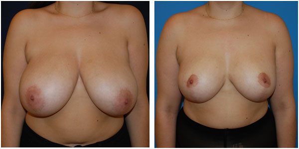 Breast reduction Front side Third