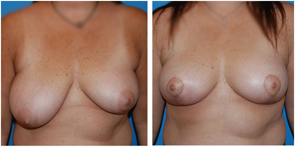Breast reduction medium front side