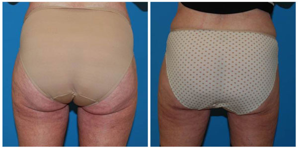 before and after picture of a woman buttocks, showcasing the liposuction achieved by Dr. J.C.