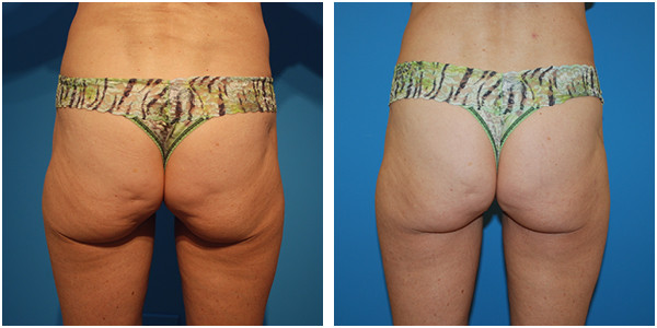 before and after picture of a woman buttocks lift, showcasing the liposuction achieved by Dr. J.C.