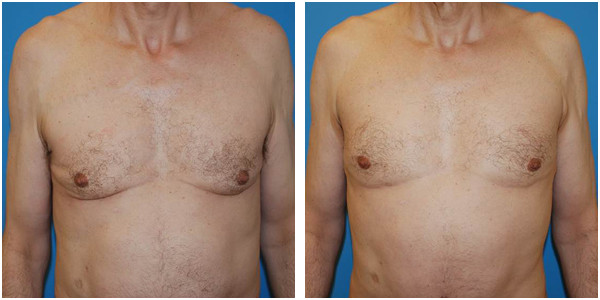 a man front side view showcasing gynecomastia before and after surgery