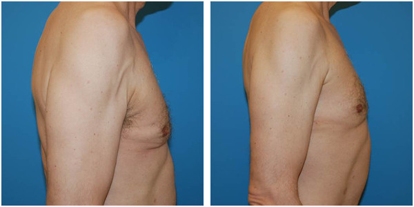a man right side view showcasing gynecomastia before and after surgery