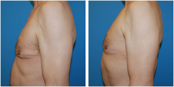 a man left side view showcasing gynecomastia before and after surgery