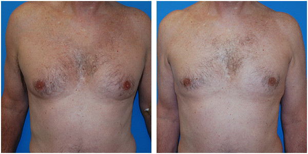a man standing chest view showcasing gynecomastia before and after surgery