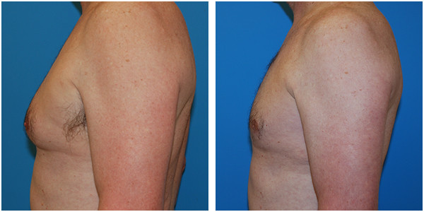 a man left side view showcasing gynecomastia before and after surgery by Dr Jennifer Capla