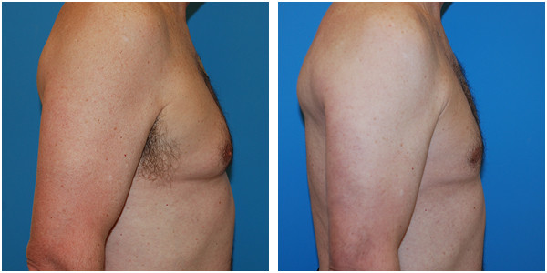 a man right side view showcasing gynecomastia before and after surgery made by Dr. Jennifer Capla