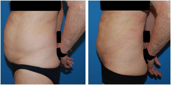 a man with hands behind left side view showcasing before and after abdomen liposuction