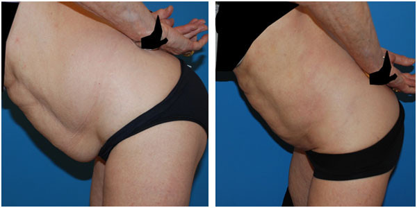a man bending left side view showcasing abdomen liposuction before and after