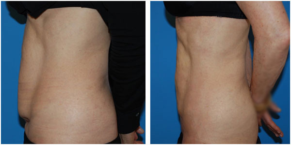 a man's abdomen left side view before and after liposuction