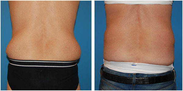 a before and after picture of a man's lower back, showcasing the transformation achieved with liposuction by Dr. J.C