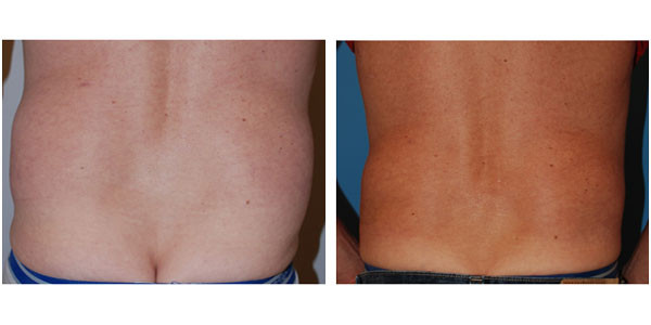 before and after picture of a man lower back's, showcasing the transformation achieved with liposuction by Dr. J.C.