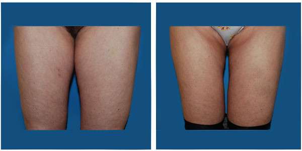 Woman Thigh front view before and after Liposuction Surgery by Dr Jennifer Capla