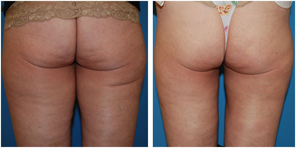 Woman Thigh Back view before and after Liposuction Surgery by Dr Jennifer Capla