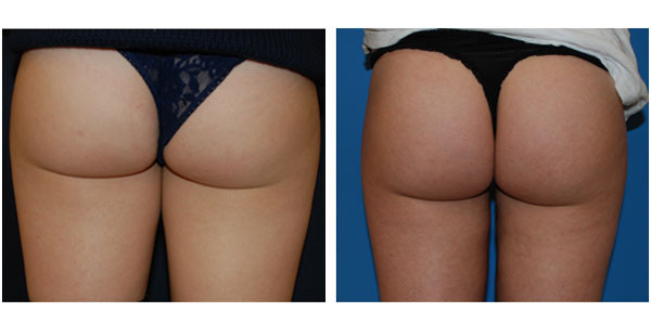 Woman Thigh back view before and after liposuction Surgery by Dr J.Capla