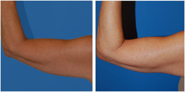 a woman left view upperarm liposuction surgery before and after