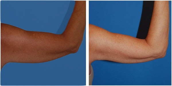 a woman right upperarm liposuction surgery before and after