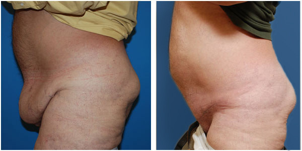 a man standing left side view showcasing results before and after panniculectomy Surgery by Dr Jennifer Capla