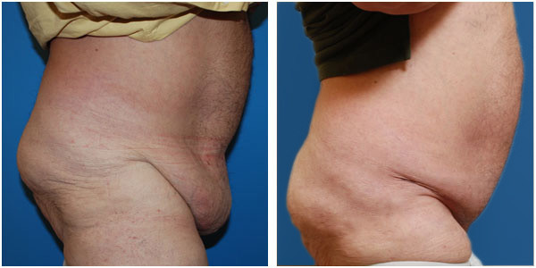 a man standing right side view showcasing before and after panniculectomy Surgery by Dr Jennifer Capla