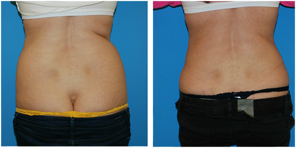 before and after picture of a woman buttocks, showcasing liposuction flanks cut achieved by Dr. J.C.