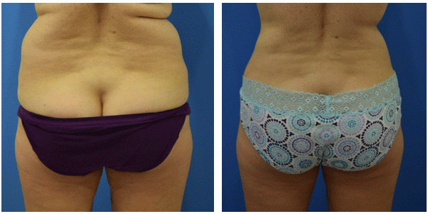 before and after picture of a woman lower back's, showcasing the liposuction achieved by Dr. J.C.