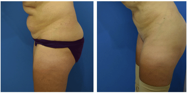 before and after left side view of a woman lower back, showcasing the liposuction achieved by Dr. J.C.