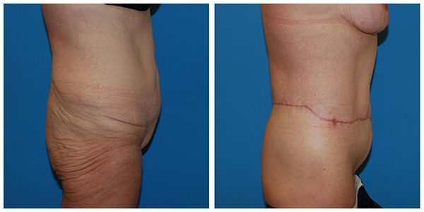 before and after images of a woman's legs, featuring J.C