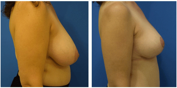 Breast reduction right side