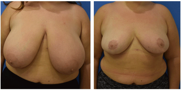 Breast reduction Front side older