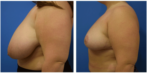 Breast reduction left side show case