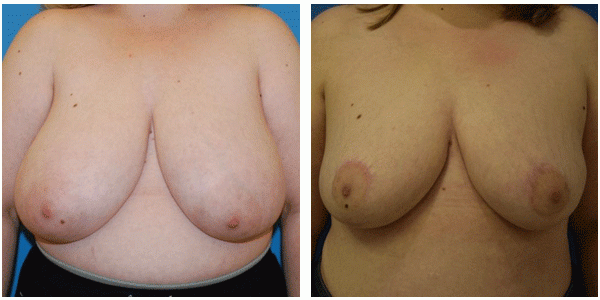 Breast reduction front side