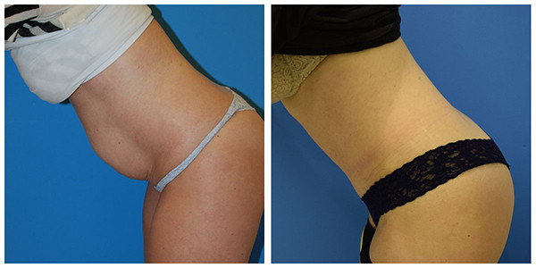 a left view of a before and after picture of a woman's butt, showcasing the transformation achieved by J.C. products