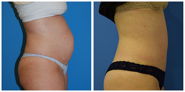 a before and after picture of a woman's butt, showcasing the transformation achieved with J.C. products